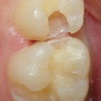 小さい虫歯