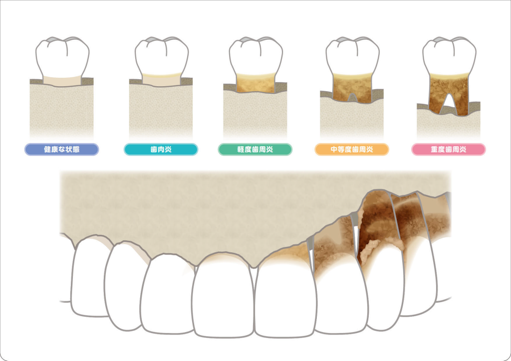 歯周病・骨の状態